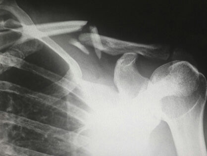 Prevention, and When Prevention Fails